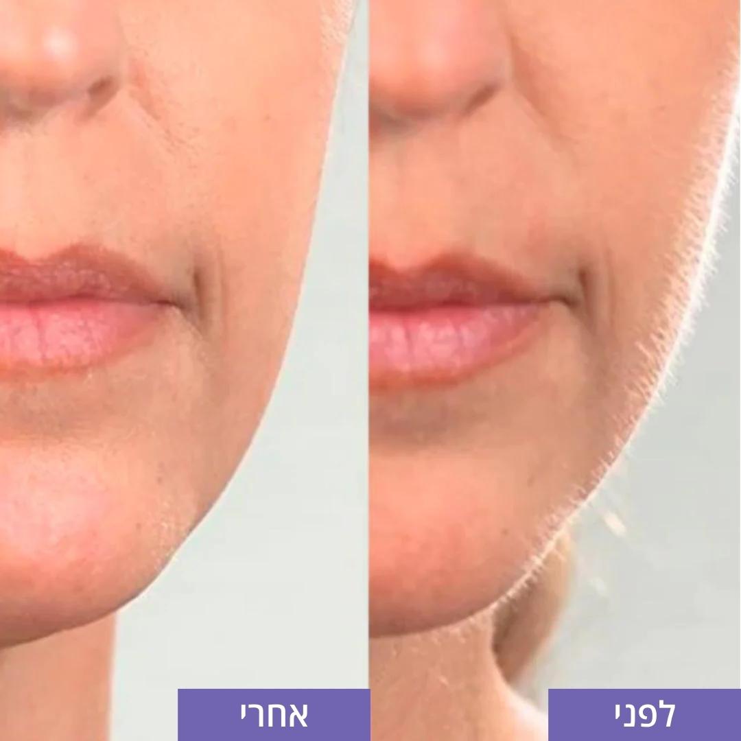 מסיר השיער בפנים